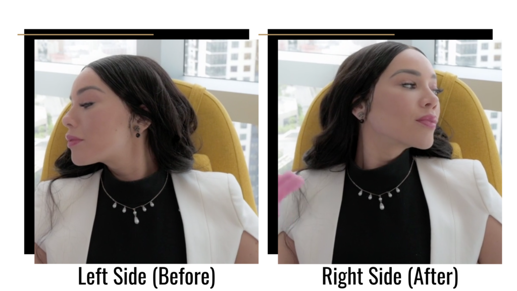 The left and right sides of Isabella's face, before and after jawline sculpting 